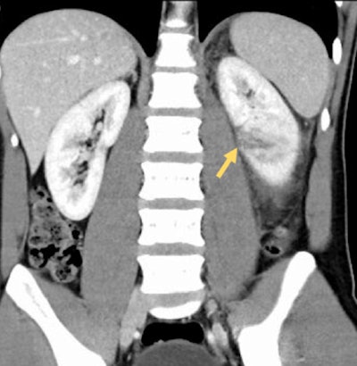 A 46-year-old man post blunt trauma following assault. A linear focus of low attenuation is visible in the lower pole of the left kidney, representing a grade III laceration.