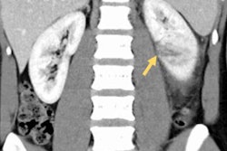 2018 06 05 16 23 1272 2018 06 05 Ct Renal2 20180605165624