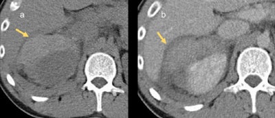 This 52-year-old man involved in a road traffic accident has a right perinephric hematoma. The irregular area of free fluid is hyperattenuating on the noncontrast study (a), indicating it is an acute hematoma.