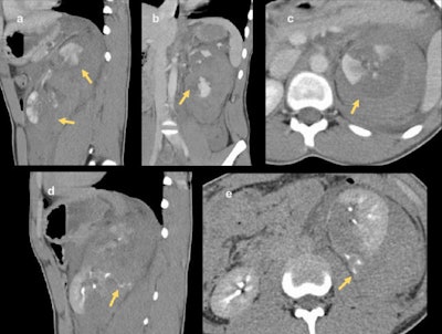 Shattered kidney in 16-year-old boy following blunt trauma in a sports match. The left kidney is divided in two (a) and (b). Extensive areas of nonattenuating parenchyma are visible in the upper pole (c) in keeping with devitalized fragments. On delayed-phase imaging (d) and (e), extravasation of contrast material from the collecting system of the lower pole can be seen. This patient subsequently underwent left nephrectomy.