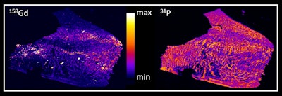 Images of tissue of the human cerebellum: On the left is gadolinium, and on the right is phosphor. Gadolinium deposition in the dentate nucleus of a patient who received the linear nonionic GBCA gadodiamide (injections of other GBCAs cannot be excluded). Accumulation of gadolinium displays within the tissue of the dentate nucleus. The structure of the tissue is visualized by displaying phosphor on the right side. Image courtesy of Prof. Uwe Kartst and Stefanie Fingerhut, PhD, University of MĂĽnster.