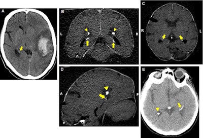Axial reconstructed brain CT scans of patients with mild (A), moderate (B-D), or severe (E) hippocampal calcifications (indicated by arrows). Image courtesy of Dr. Pim de Jong, PhD.