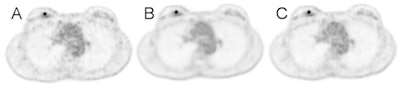 A 49-year-old patient with an invasive breast cancer. The FDG-avid, 8-mm lesion is shown in the axial image on the right side. The patient was injected with 218 MBq of FDG (body weight of 73 kg) A: Two-minute TOF, B: 100% of FDG dose, C: 44 MBq (20% dose), D: 22 MBq (10% dose), E: 11 MBq (5% dose), F: corresponding contrast enhanced MRI image. For a PET/MRI examination with the images shown in D, this patient would receive an estimated radiation burden of 0.44 mSv. All images courtesy of Dr. Bert-Ram Sah.