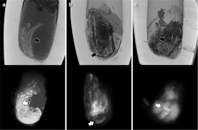 CT reconstructions (top) and correlative maximum intensity projections of MRI scans (bottom) of the three canopic jars with solid contents. Black arrows (CT) and white arrows (MRI) indicate corresponding structures of organ fragment like morphology, probably intestine.
