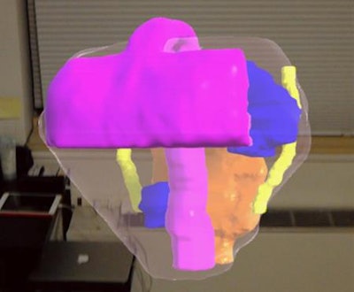 A prostate (clear) visualized through the HoloLens augmented reality device, including cancerous lesions (blue), bladder neck and urethra (purple), neurovascular bundles (yellow), and rectal wall (orange). Image courtesy of Nicole Wake, doctoral candidate.