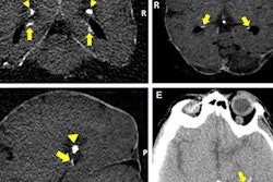 2018 06 28 17 37 9084 Ct Hippocampal Calcification 20180628174457