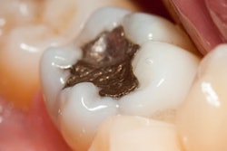 2018 06 28 18 59 0292 Amalgam Filling 400