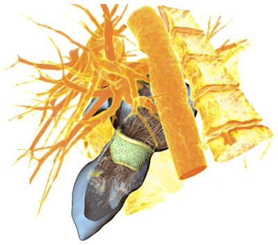 3D heart valve model with corresponding blood flow simulation. Image courtesy of Anja Hennemuth, PhD.
