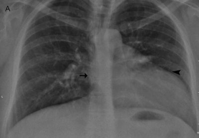 Above A: Frontal chest radiograph shows displacement of the cardiac silhouette to the left, with flattening and elongation of the left ventricular contour (arrowhead) and obliteration of the right cardiac border (arrow). Below B: Gradient-recalled echo axial MRI shows complete absence of the left pericardium (arrowheads), with obliteration of pericardial fat and a partial right-sided pericardium (arrows) seen as a dark, thin stripe sandwiched between the epicardial and pericardial fat. Images courtesy of Dr. Stavroula Theodorou and Dr. Daphne Theodorou, PhD.