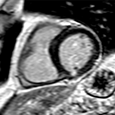 2018 07 17 21 46 8735 Lge Cardiac Mri Plos One 20180717211523