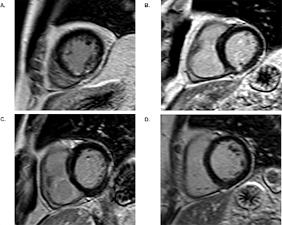 LGE cardiac MR images show patients with and without unrecognized myocardial infarctions (UMIs): (A) subendocardial UMI, (B) transmural UMI, (C) area of LGE with no myocardial infarction, and (D) no LGE and normal myocardium. Images courtesy of PLOS One.