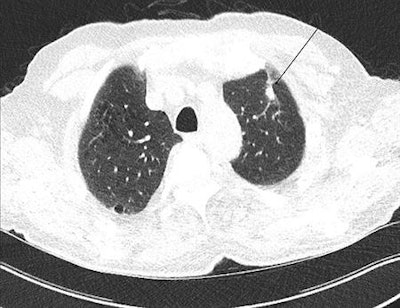 In this low-dose CT scan, the arrow points to a cancer in the left upper lobe.