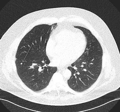 Arrow shows a benign nodule in the right lower lobe visualized on a low-dose screening CT. All images courtesy of Dr. Thomas Frauenfelder.