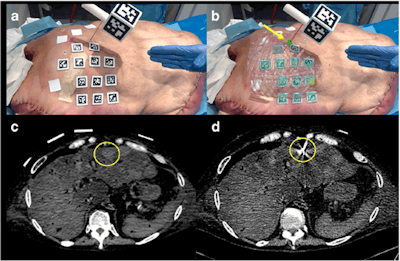 Needle insertion into a liver tumor without augmented reality (a) and with augmented reality (b) displaying the needle (red) and target (green) on the cadaver. Corresponding CT scans highlight the area of interest before needle insertion (c) and after (d). Image courtesy of Dr. Marco Solbiati.