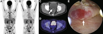 A 40-year-old man with plasmablastic lymphoma and multiple bone lesions underwent FDG-PET at baseline (A) and six months later (B). CT shows a focal hyperdense lesion at the bladder floor (C, arrow) that is not clearly visible on fused FDG-PET/CT (D). The FDG-PET/CT report included a strong recommendation for focused ultrasonography to evaluate the bladder lesion. However, the referring physician disregarded the recommendation for unclear reasons. Six months later, the patient presented with hematuria, and cystoscopy showed a bladder tumor, which was removed by transurethral resection (E, arrow). Images courtesy of JACR.