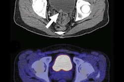 2018 08 03 22 39 3249 2018 08 06 Fdg Pet Ct Jacr Alesawi 400