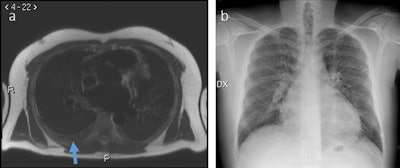 A 32-year-old man with pleural effusion visible at MRI (arrow in panel a) but not clearly visible at chest x-ray (panel b).