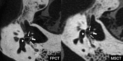 Footplate of the stapes (arrowhead), anterior and posterior crus (arrows), and head of the stapes (thick arrow). Flat-panel CT depicts all the components of the stapes better compared with multidetector CT, thanks to its higher spatial resolution and smaller field-of-view, which allows a magnified view. Courtesy of Dr. Giorgio Conte.