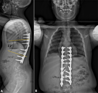 Postoperative x-ray showing correction of the spinal deformity.