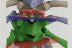 2018 08 14 17 50 9440 2018 08 14 3 D Printed Spine 20180814171111
