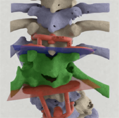 A 3D-printed spine model with 3D-printed osteotomy templates (red). All images courtesy of Pijpker et al. CC BY 4.0.