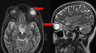 T2-weighted MRI scan of the head: transverse and sagittal views. Red arrows show high-intensity signal nodular lesion in the left upper eyelid. Image courtesy of BMJ Case Reports.