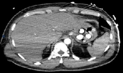CT pulmonary angiogram of a 43-year-old man who presented with an out of hospital cardiac arrest. No embolism was detected, but four well-defined radiopaque densities (~300 Hounsfield units) were identified in the stomach. All images courtesy of Drs. Nirav Bhatt and Sheena McLaggan.