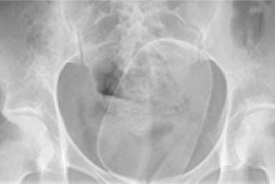X-ray of 24-year-old woman shows a solitary well-defined radiopaque density lying within the pelvis, outside of the bowel lumen.