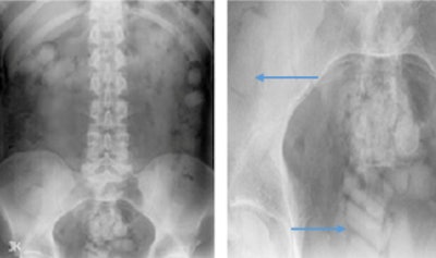 X-rays show smooth, well-defined radiopaque densities scattered throughout the bowel lumen. Blue arrows demonstrate the characteristic 'double condom' sign.