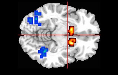 MRI shows activity (red and yellow areas) in the caudate region of the brain, which is affected in people with psychosis. Image courtesy of King's College London.