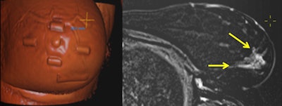 A 41-year-old patient with a large multifocal ductal cancer in the lower lateral quadrant of the left breast. Preoperative prone MRI showed a new large area of segmental nonmass enhancement in the upper quadrant of the same breast (not shown). A shaded, volume-rendered reconstruction image of supine MRI side by side to an axial subtraction image allows physicians to visualize the MRI-only detected lesions (arrows) in the surgical position and also navigate in real-time through the lesion and appreciate its extent as projected by a 'crosshair' tool on the skin, also allowing measurements of distances in relation to the MRI-visible capsules positioned on the skin before scanning. All images courtesy of Dr. Sarianna Joukainen.