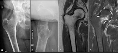 Example of a fracture of the femoral neck that is radiographically occult (a) and (b), but readily demonstrable on (c) T1-weighted and (d) short tau inversion recovery MRI. References: Derriford Hospital - Derriford/U.K. All images courtesy of Dr. Jenn Shiunn Wong.