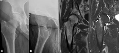 Another example of a fracture of the femoral neck that is radiographically occult (a) and (b), but readily demonstrable on (c) T1-weighted and (d) short tau inversion recovery MRI. References: Derriford Hospital - Derriford/U.K.
