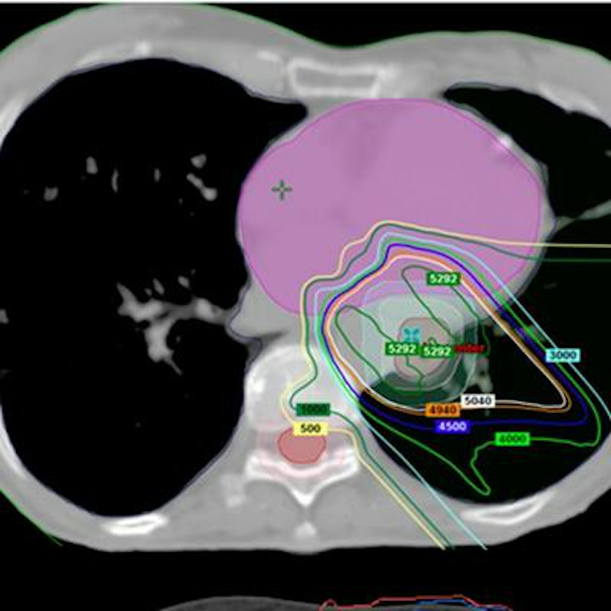 FDG-PET/CT can provide valuable esophageal cancer updates ...