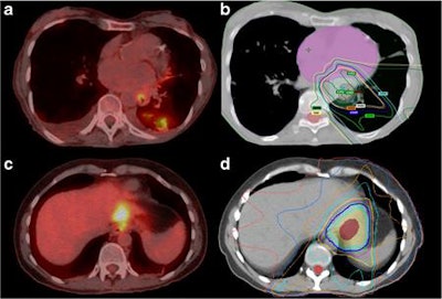 Images show examples of new nonmalignant FDG-avid lesions detected by FDG-PET/CT restaging. A 78-year-old woman (a) with squamous cell carcinoma of the esophagus treated with chemoradiation. PET/CT shows new opacities within the left lower lobe with corresponding areas of FDG activity. The new lesion was within the presumed radiation field (b) and the appearance was most compatible with radiation-induced pneumonitis. Scan was a true-negative for new metastatic disease. A 42-year-old woman (c) undergoing chemoradiotherapy for adenocarcinoma of the distal esophagus. PET/CT shows linear FDG accumulation within the lateral aspect of the left hepatic lobe. A new lesion was within the presumed radiation field (d) and thought to be related to radiation therapy changes. It was a false-positive on MRI, which was required to exclude metastatic disease. Images courtesy of EJNMMI.