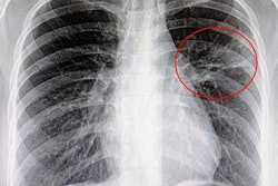 2018 08 27 20 04 8586 Lung Pneumonia Cad2 20180827201807