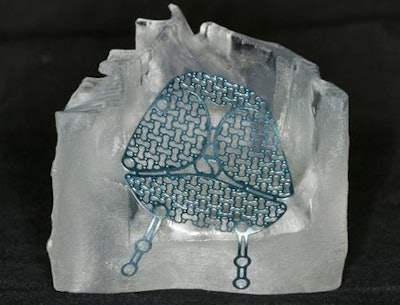 Patient-specific 3D-printed model allows for the presurgical preparation of hybrid titanium mesh implants for orbital floor reconstruction.