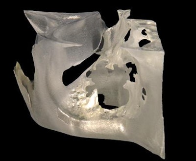 3D-printed anatomical guide for craniomaxillofacial surgeries. All images courtesy of Stratasys.