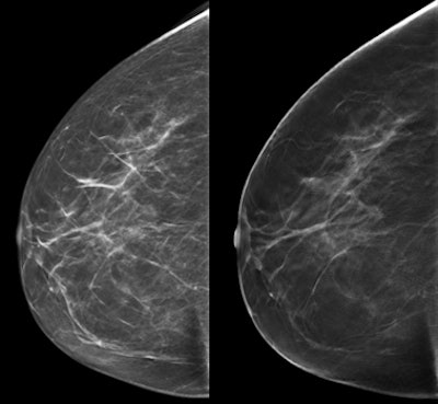 An example of screen-detected invasive carcinoma (dorsal positioning). It was difficult to see on 2D (left) but clearly visible on DBT (right). All images courtesy of Dr. Hildegunn Aase and Solveig Hofvind, PhD.