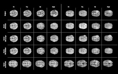 Examples of synthetic brain MR images generated by the GAN. The first row depicts the real images on which the synthetic tumors were based. The second row shows the generated images without adjustment of the segmentation label, while the third through fifth rows provide examples of generated images with various adjustments to the tumor segmentation label. The last row includes examples of synthetic images with a tumor label placed on a tumor-free brain MRI. Image courtesy of NVIDIA.