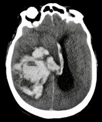 autopsy_CT
