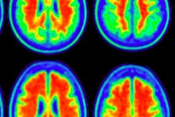 2018 09 27 18 51 6561 Florbetaben Pet Amyloid Ejnmmi 20180927180949