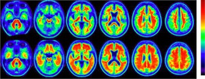 PET images show levels of florbetaben uptake in amyloid in relation to mild cognitive impairment. Average axial slices of mild amyloid load compare low uptake (amyloid negative) (top row) and uptake with high amyloid load (amyloid positive) (bottom row). Image courtesy of EJNMMI.