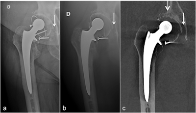 Anteroposterior x-ray (a), anteroposterior tomosynthesis (b), and coronal CT-metal artifact reduction reformat (c) of a cemented right-sided total hip arthroplasty. Note the doubtful osteolysis in zone III in image a, better depicted in image b but clearly better seen in image c. There is also osteolysis in zone I, only seen in image c. All images courtesy of Dr. Romain Gillet.