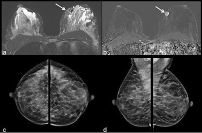 Images of a 40-year-old patient with invasive ductal carcinoma in the left breast at 9 o'clock. The tumor (white arrow) was displayed in the MR images (a = T2 short-tau inversion recovery, b = contrast-enhanced subtraction image). Due to high density of the lactating breast tissue the mass was occult on mammography (c = craniocaudal and d = mediolateral oblique view of both sides). Windowing of MR images was adapted accordingly. Images courtesy of European Radiology.