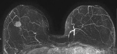 Same patient as above. An abbreviated breast MRI (MIP image).