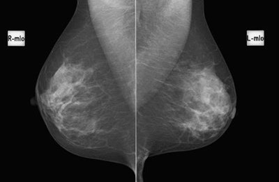 A bilateral digital mammogram (ACR category C breast, BI-RADS 1) of a 53-year-old patient with grade 3 no special type breast cancer in the right breast. All images courtesy of Dr. Christiane Kuhl.
