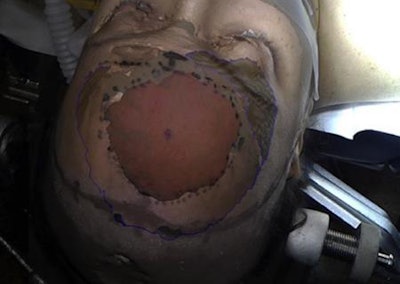 Mixed reality view of a hologram of a brain tumor directly on the patient's head. The tumor (red) is outlined. Image courtesy of Dr. Fatih Incekara.