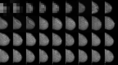 Image taken from high-resolution mammogram synthesis using progressive generative adversarial networks. Courtesy of Korkinof et al., Kheiron Medical Technologies, https://arxiv.org/abs/1807.03401.