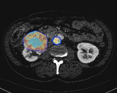 In this image, the tumor is segmented to define a region of interest in which radiomics parameters are calculated. All images courtesy of Dr. Laure Fournier, PhD.
